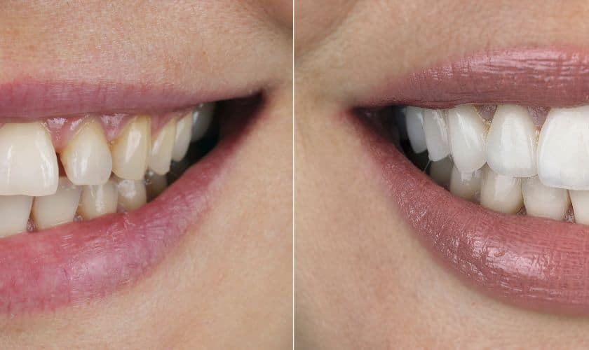 Teeth Whitening for Aging Smiles